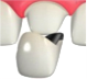 メタルボンド冠