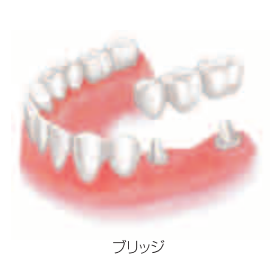 ブリッジ治療のイメージ