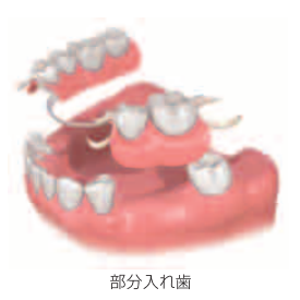 部分入れ歯のイメージ