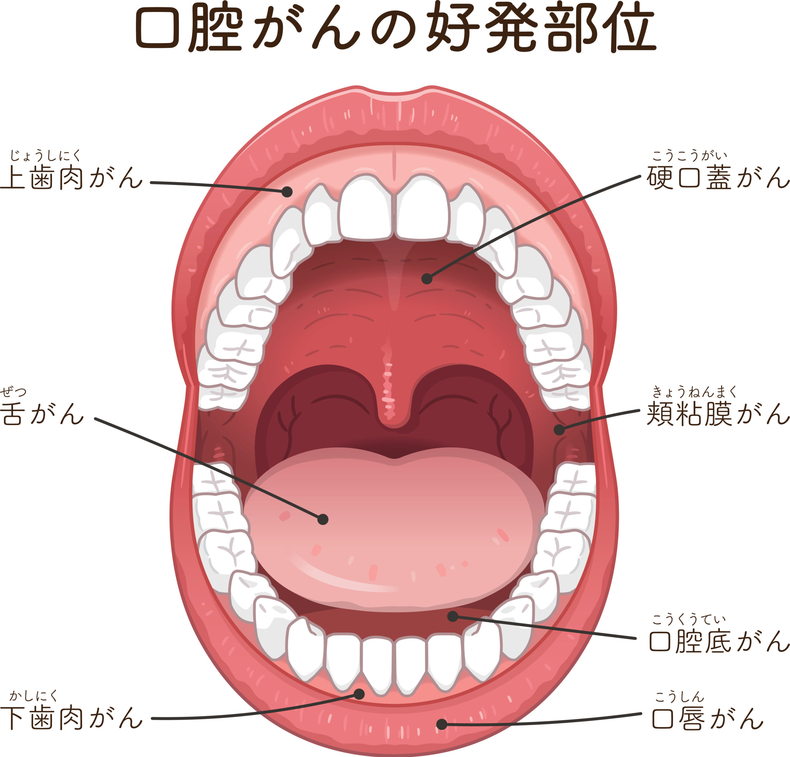 口腔がんの特徴